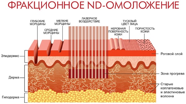 Lifting du visage: qu'est-ce que c'est, SMAS, RF, plasma, massage, ultrasons, filament, endoscopique, ondes radio, vecteur, radiofréquence, laser, acupuncture