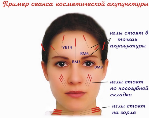 Lifting du visage: qu'est-ce que c'est, SMAS, RF, plasma, massage, ultrasons, filament, endoscopique, ondes radio, vecteur, radiofréquence, laser, acupuncture