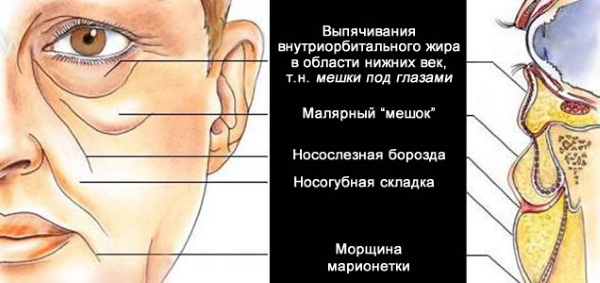 Lipolytiques pour le visage, le menton, le nez. Résultats de l'application, prix, effets secondaires des injections de mésothérapie