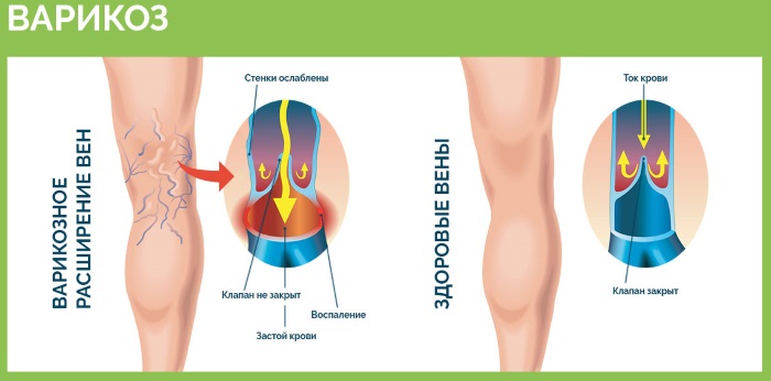 Massage au miel pour la cellulite. Comment le faire correctement pour perdre du poids sur l'abdomen, le dos, les jambes, les fesses à la maison. Cours vidéo