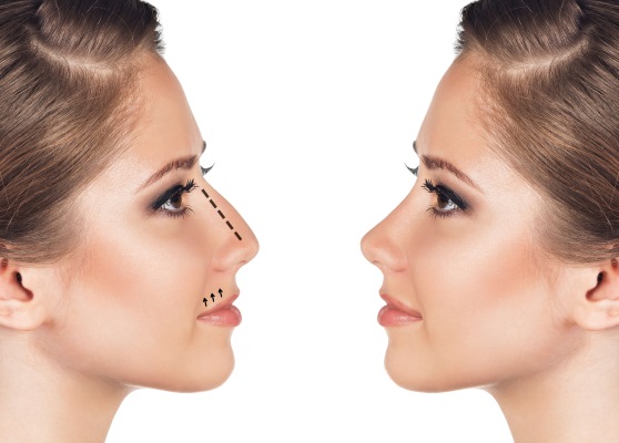 Chirurgie plastique du nez. Types, prix: correction du septum, réduction du nez, suppression de la bosse, remodelage, rhinoplastie de contour