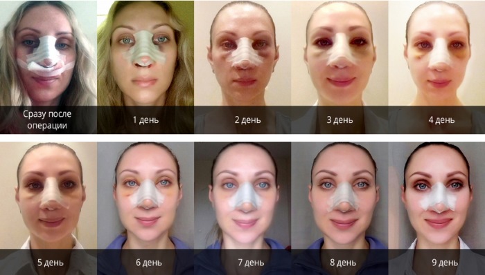 Chirurgie plastique du nez. Types, prix: correction du septum, réduction du nez, suppression de la bosse, remodelage, rhinoplastie de contour