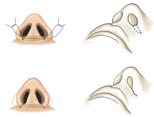 Chirurgie plastique du nez. Types, prix: correction du septum, réduction du nez, suppression de la bosse, remodelage, rhinoplastie de contour