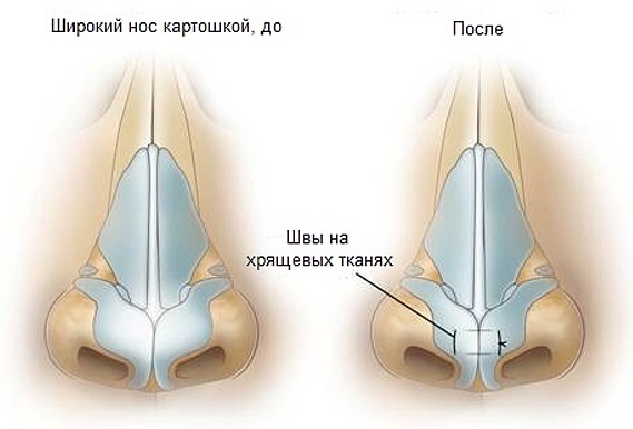 Chirurgie plastique du nez. Types, prix: correction du septum, réduction du nez, suppression de la bosse, remodelage, rhinoplastie de contour