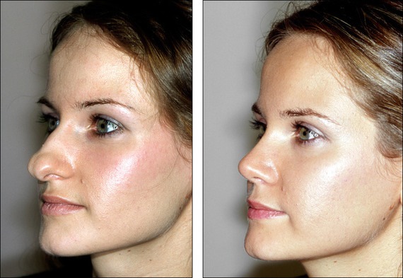 Chirurgie plastique du nez. Types, prix: correction du septum, réduction du nez, suppression de la bosse, remodelage, rhinoplastie de contour