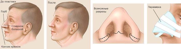 Chirurgie plastique du nez. Types, prix: correction du septum, réduction du nez, suppression de la bosse, remodelage, rhinoplastie de contour