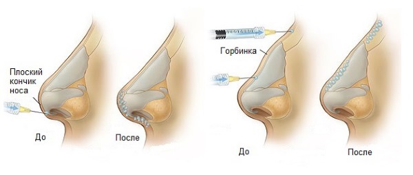 Chirurgie plastique du nez. Types, prix: correction du septum, réduction du nez, suppression de la bosse, remodelage, rhinoplastie de contour