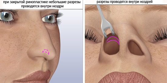 Chirurgie plastique du nez. Types, prix: correction du septum, réduction du nez, suppression de la bosse, remodelage, rhinoplastie de contour