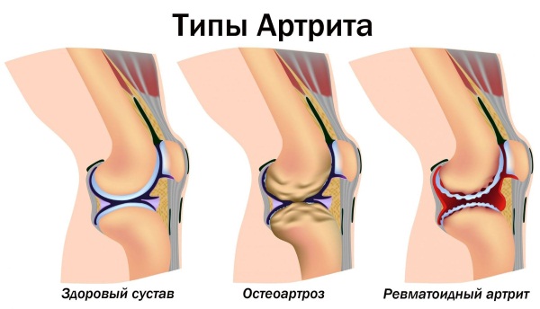 Onguents chauffants pour les muscles et les articulations: principe d'action, indications et contre-indications, caractéristiques d'application, médicaments peu coûteux