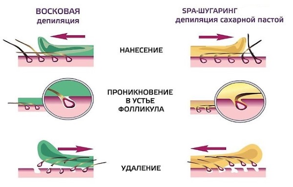 Épilation à la cire ou sucre? Quoi de mieux dans la zone profonde du bikini, les jambes, les aisselles