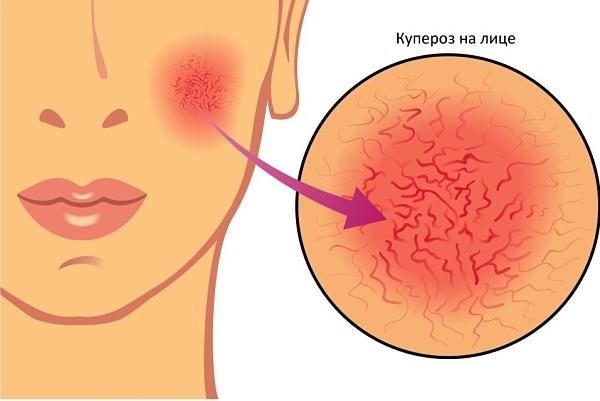 Bodyagu pour le visage contre les ecchymoses, l'acné, les taches de vieillesse. Instructions, recettes d'utilisation, résultats et photos