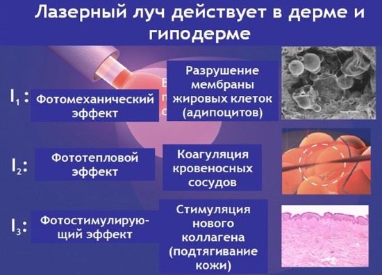 Liposuccion au laser. Qu'est-ce que c'est, comment est-ce fait pour l'abdomen, le menton, le visage, les cuisses, les joues, les jambes, les fesses, les bras, la bosse de la veuve. Photos avant et après, avis, prix de la procédure