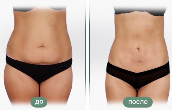 Liposuccion au laser. Qu'est-ce que c'est, comment est-ce fait pour l'abdomen, le menton, le visage, les cuisses, les joues, les jambes, les fesses, les bras, la bosse de la veuve. Photos avant et après, avis, prix de la procédure