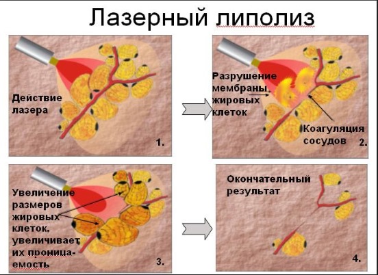 Liposuccion au laser. Qu'est-ce que c'est, comment est-ce fait pour l'abdomen, le menton, le visage, les cuisses, les joues, les jambes, les fesses, les bras, la bosse de la veuve. Photos avant et après, avis, prix de la procédure