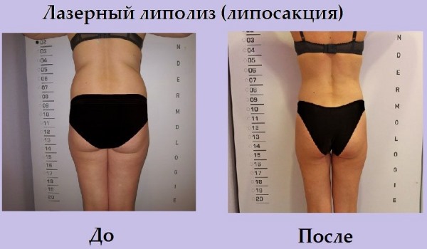 Liposuccion au laser. Qu'est-ce que c'est, comment est-ce fait pour l'abdomen, le menton, le visage, les cuisses, les joues, les jambes, les fesses, les bras, la bosse de la veuve. Photos avant et après, avis, prix de la procédure