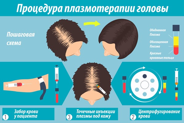 Thérapie plasma pour les cheveux et le cuir chevelu: qu'est-ce que c'est, résultats, indications et contre-indications