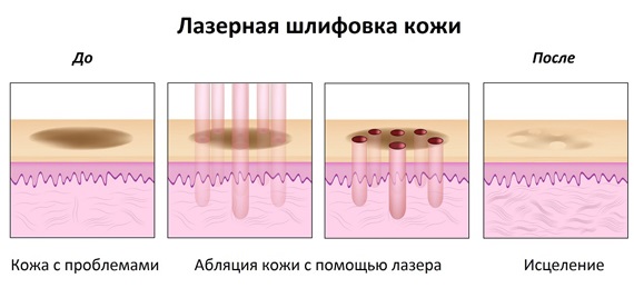 Le resurfaçage du visage. Photos avant et après laser, CO2, diamant, fractionnaire, radiofréquence. Avantages et inconvénients, étapes, rééducation