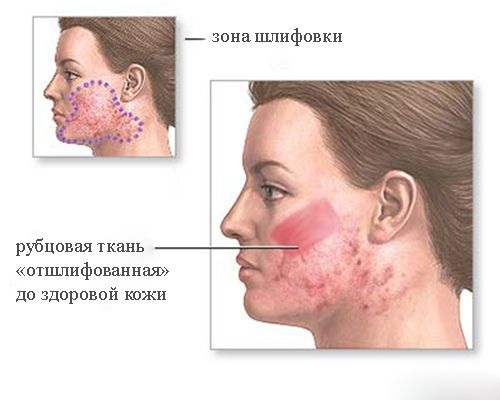 Le resurfaçage du visage. Photos avant et après laser, CO2, diamant, fractionnaire, radiofréquence. Avantages et inconvénients, étapes, rééducation