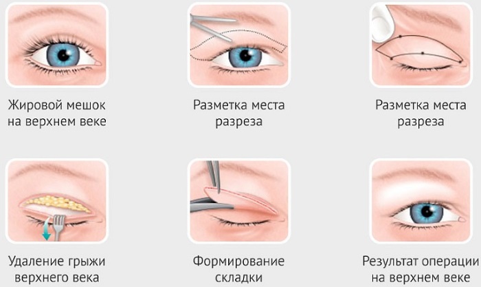 Blépharoplastie à Moscou. Prix ​​en 2020, évaluation des cliniques, comment choisir un chirurgien, promotions, réductions