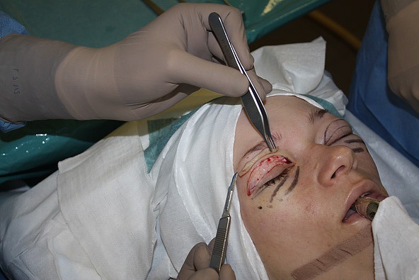 Blépharoplastie à Moscou. Prix ​​en 2020, évaluation des cliniques, comment choisir un chirurgien, promotions, réductions