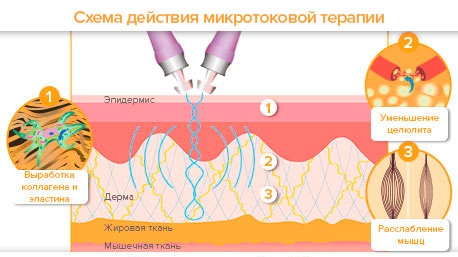 Massage de drainage lymphatique des jambes, des cuisses, de l'abdomen avec lymphostase, varices, œdème, varices, grossesse. Technique comment le faire vous-même