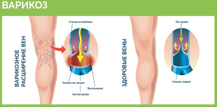 Corde à sauter pour perdre du poids.Tableau contre la cellulite, combien de calories sont brûlées. Bénéfice et préjudice, technique, résultats