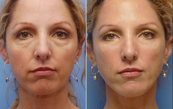 Remplissage Restylane, bio-revitalisation. Commentaires. Vital, Perline, Skinbooster pour l'augmentation des lèvres, sous les yeux. Prix, efficacité, photo