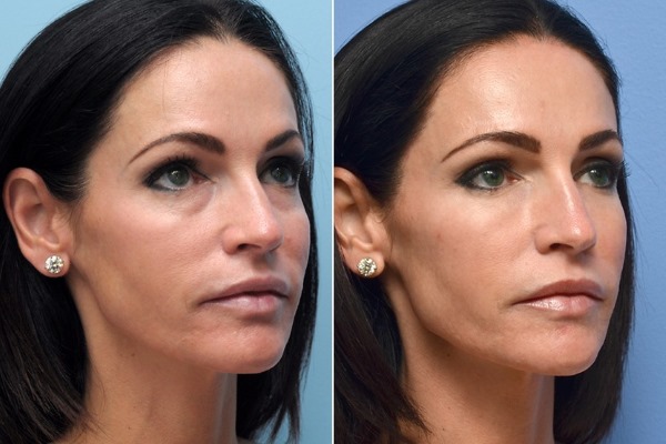 Remplissage Restylane, bio-revitalisation. Commentaires. Vital, Perline, Skinbooster pour l'augmentation des lèvres, sous les yeux. Prix, efficacité, photo