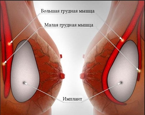 Augmentation mammaire. Coût à Moscou, Saint-Pétersbourg. Types d'implants, prix