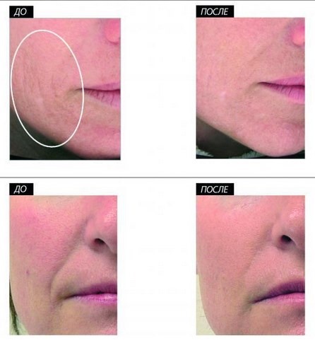 Hydropeeling sous vide Hydra Feshl hydrafacial. Quelle est cette procédure, description, appareils, prix