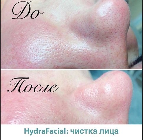 Hydropeeling sous vide Hydra Feshl hydrafacial. Quelle est cette procédure, description, appareils, prix