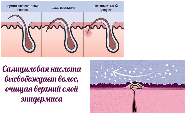 Poils incarnés sur les jambes, dans la zone du bikini, poils pubiens après shugaring, épilation. Le traitement signifie: onguents, lotions, crèmes, gommages, badyaga, Bepanten, Levomekol