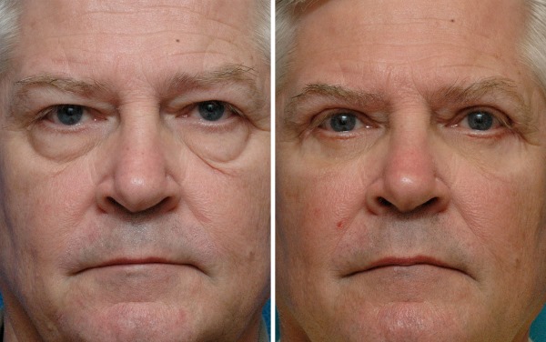 Blépharoplastie. Avis des opérés. Avantages et inconvénients de la chirurgie plastique, complications, rééducation. Laser, transconjonctival, circulaire, injection