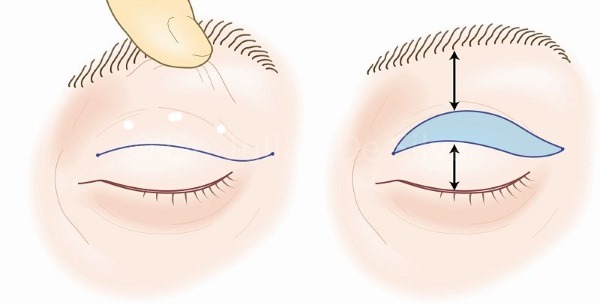 Blépharoplastie. Avis des opérés. Avantages et inconvénients de la chirurgie plastique, complications, rééducation. Laser, transconjonctival, circulaire, injection