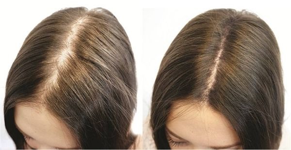 Darsonval pour les cheveux. Avis, instructions pour utiliser les peignes pour la croissance, de la perte. Prix