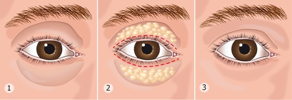 Blépharoplastie au laser.Examens des paupières inférieures et supérieures opérées, comment ils le font. Des prix