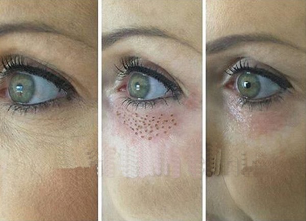 Blépharoplastie au laser. Examens des paupières inférieures et supérieures opérées, comment ils le font. Des prix