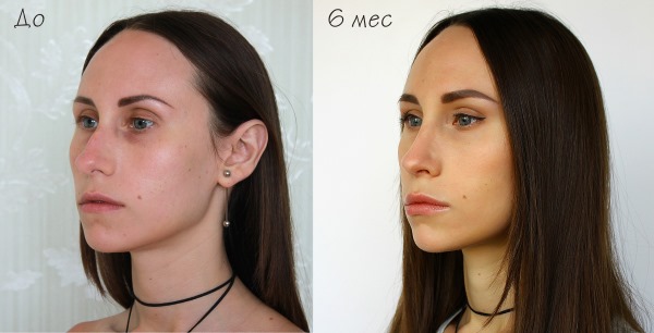 Rhinoplastie à Moscou. Prix ​​et avis des cliniques dans la capitale