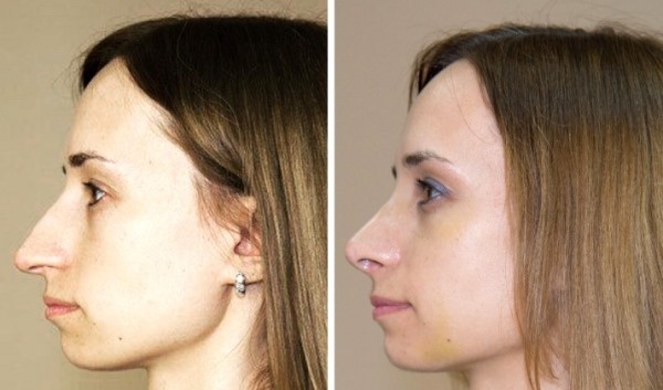 Rhinoplastie à Moscou. Prix ​​et avis des cliniques dans la capitale