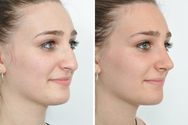 Rhinoplastie à Moscou. Prix ​​et avis des cliniques dans la capitale