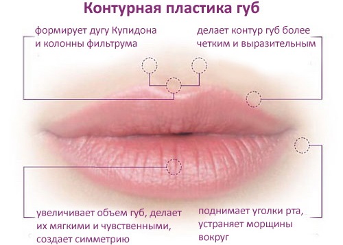 Comment agrandir les lèvres avec de l'acide hyaluronique, du botox, du silicone, du lipofilling, de la cheiloplastie. Photos, prix, avis