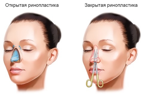 Rhinoplastie à Moscou. Prix ​​et avis des cliniques dans la capitale