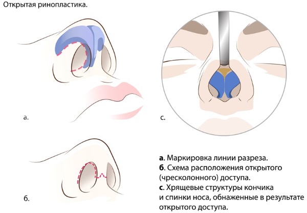 Rinoseptoplastie. Qu'est-ce que c'est, ouvert, fermé, chirurgie au laser, période de rééducation, prix