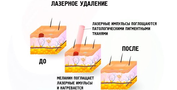 Élimination des taches de vieillesse sur le visage avec un laser, un flash photo, de l'azote liquide, des remèdes populaires