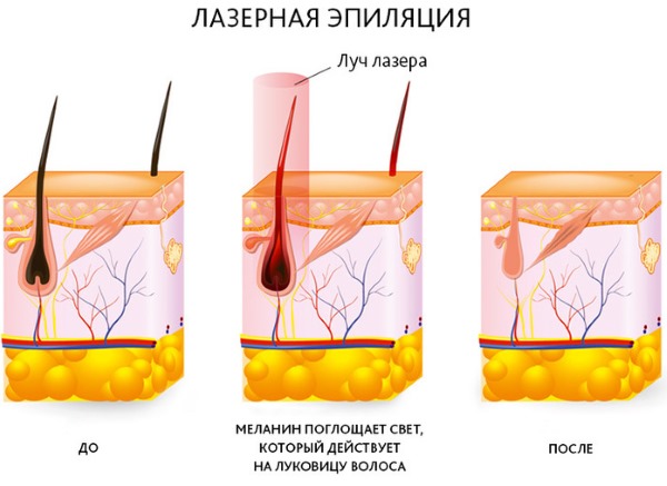 Épilation au laser alexandrite. Qu'est-ce que c'est, les avantages et les inconvénients de la procédure, le coût