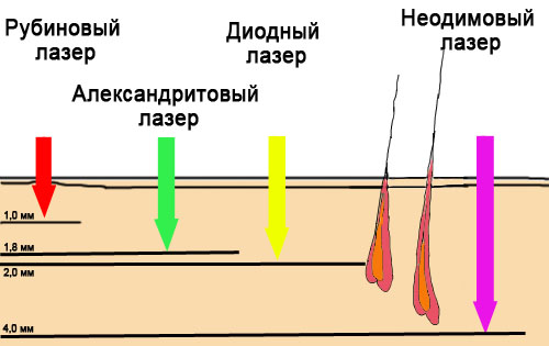 Épilation au laser alexandrite. Qu'est-ce que c'est, les avantages et les inconvénients de la procédure, le coût