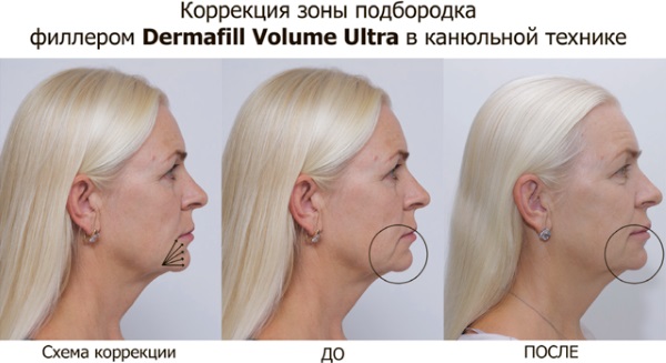 Contour du visage par injection. Ce que c'est. Photos avant et après, préparatifs, prix