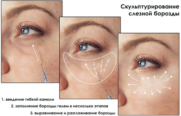 Contour du visage par injection. Ce que c'est. Photos avant et après, préparatifs, prix