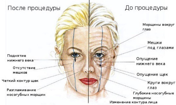 Contour du visage par injection. Ce que c'est. Photos avant et après, préparatifs, prix