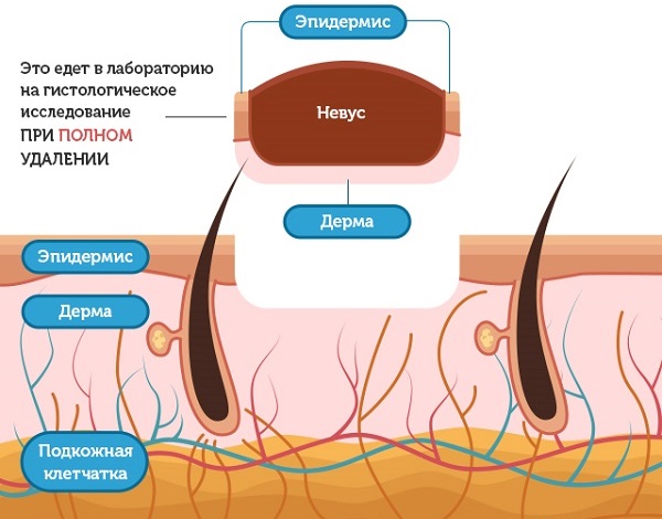 Comment se débarrasser des grains de beauté sur le visage avec une esthéticienne, méthodes à la maison